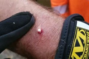 Airsoft BB Stuck In Skin? Simple Guide & Safe Removal Tips | Ultimate Airsoft Guide for Beginners, Tactics & Gear Reviews
