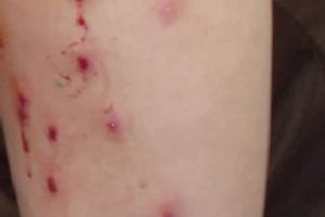 Airsoft Bruises: Prevent & Treat Your Airsoft Marks Ultimate Airsoft Guide for Beginners, Tactics & Gear Reviews Airsoft Bruises: Prevent & Treat Your Airsoft Marks | Ultimate Airsoft Guide for Beginners, Tactics & Gear Reviews